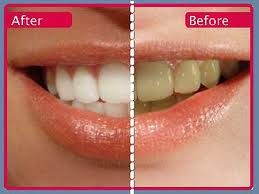 Reasons Dentists Love Life-Like Teeth Whitening
