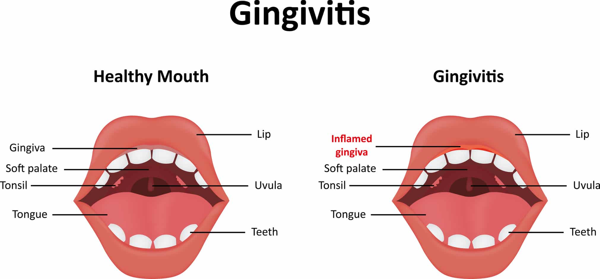 Gingivitis Illustration
