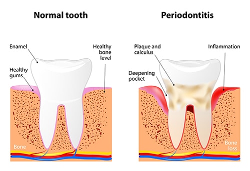 gum-disease3